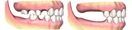 2 teeth