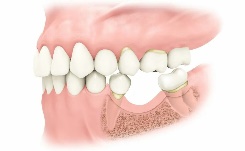 1teeth